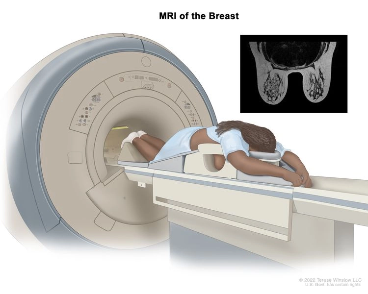 Illustration of a woman lying face down for a breast MRI scan, positioned on a specialized table inside the MRI machine. An inset image shows the resulting breast MRI scan displaying internal breast structures.