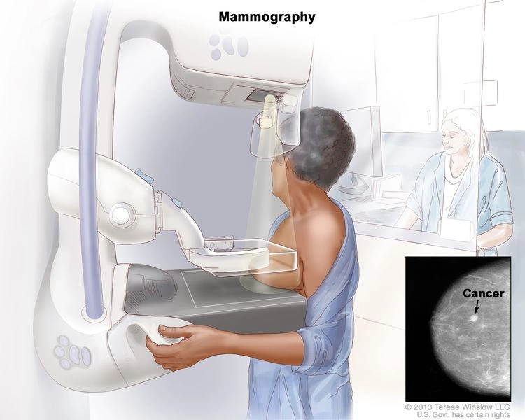 Illustration of a woman undergoing a mammogram, showing breast compression in a mammography machine with a technician operating it in the background. An inset image displays a mammogram with a labeled cancer spot